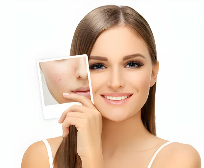 Understanding and Treating Acne: A Complete Guide - Witapedia